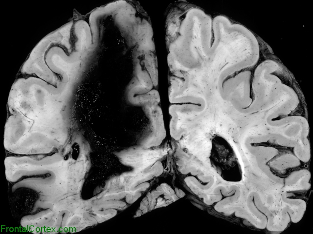 Lobar Hemorrhage, Coronal section through parietal lobes